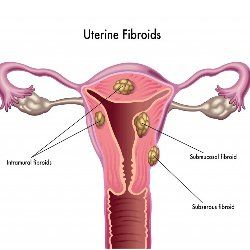 Communément recommandé régime pour rétrécir les fibromes utérins