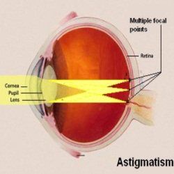 Remèdes naturels efficaces pour astigmatisme