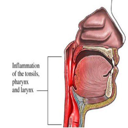 Pharyngite
