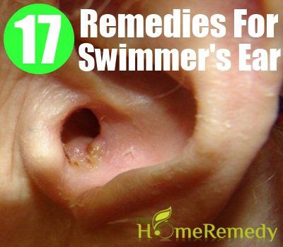 remèdes maison pour l'oreille nageurs