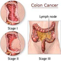 Cancer du Colon