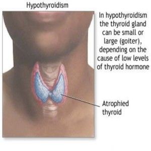 L'hypothyroïdie