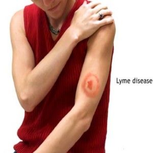 Remèdes pour la maladie de Lyme