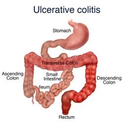 Colite ulcéreuse