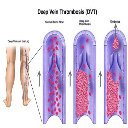 Accueil recours pour la thrombose veineuse profonde