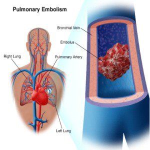 Accueil recours pour l'embolie pulmonaire