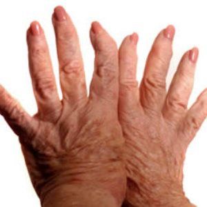 les symptômes de l'arthrite