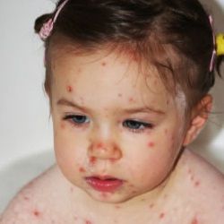 Comment prévenir la varicelle
