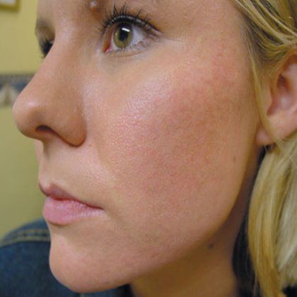 Comment se débarrasser des marques d'acné