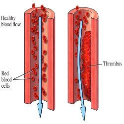 Comment prévenir les caillots sanguins