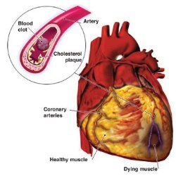 Comment prévenir les maladies cardiovasculaires