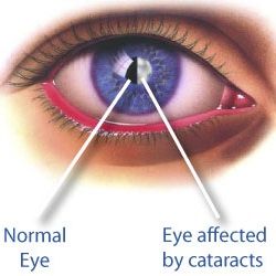 Comment prévenir les cataractes