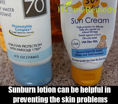 Sunburn lotion