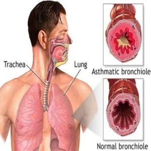 Comment traiter l'asthme