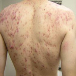 Comment traiter l'acné de corps