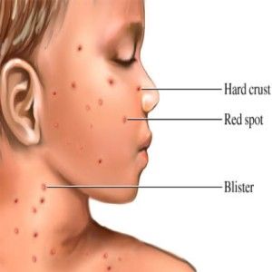 Comment traiter la varicelle