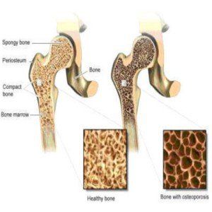 Remèdes naturels pour l'ostéoporose