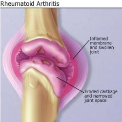 Remède naturel pour l'arthrite rhumatoïde