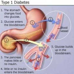 Top 5 des vitamines pour le diabète de type 1