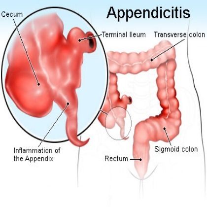 Remèdes naturels pour l'appendicite