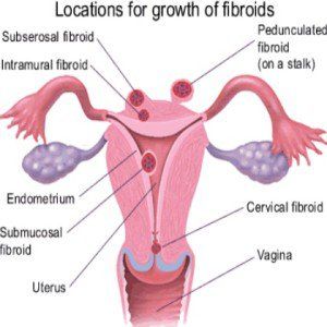 Remède naturel simple pour les fibromes