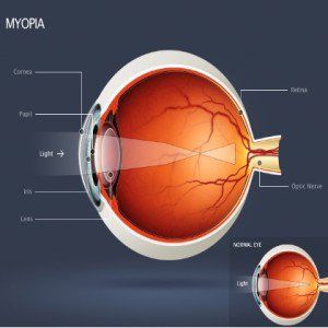 Top 6 des exercices oculaires pour la myopie