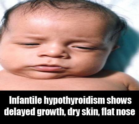 Infantile hypothyroïdie