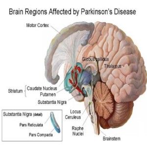 Yoga pour la maladie de Parkinson